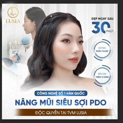 Nâng mũi siêu sợi