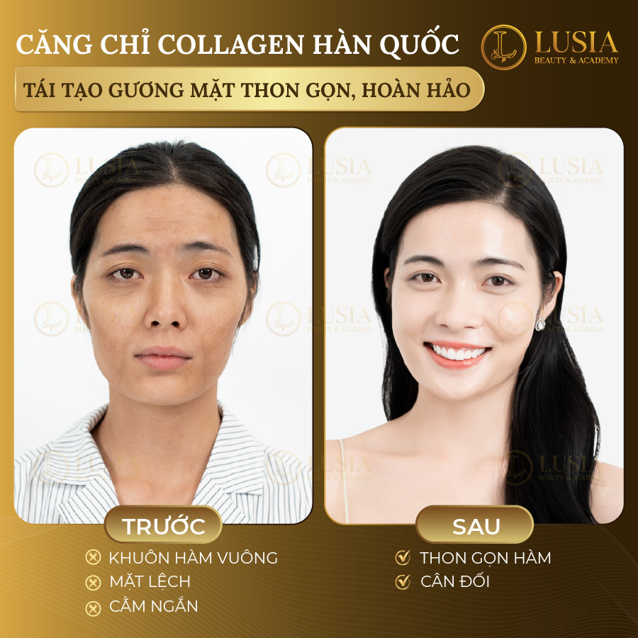 Căng chỉ Collagen Hàn Quốc